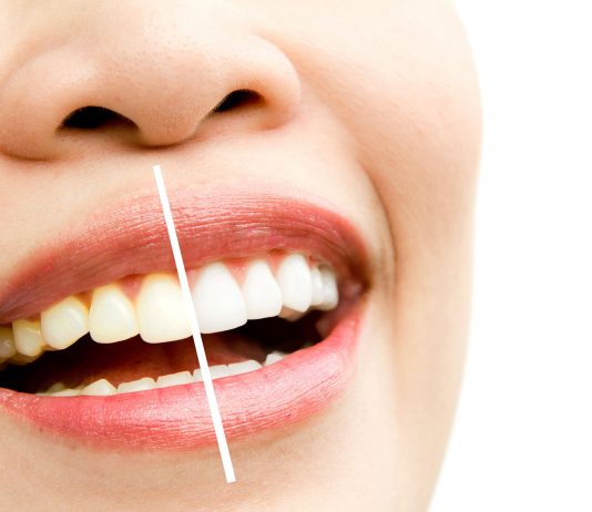 Relação perigosa: álcool e saúde bucal